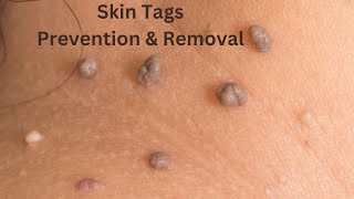 How To Remove and Prevent Skin Tags [upl. by Leventis]