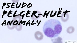 Pseudo PelgerHuët Anomaly Peripheral Blood Smear Hematopathology Hematology [upl. by Grunenwald]