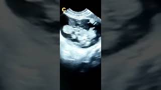 OVARIAN CYSTIC TERATOMA DERMOID CYST [upl. by Melas]