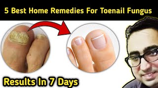 Top 5 Remedies To Cure Nail Fungus Just In 7 Days At Home  Pharmacist Javaid [upl. by Freemon138]