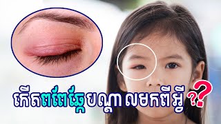 តើការកើតពពែឆ្កែបណ្តាលមកពីអ្វីWhat is Chalazion [upl. by Priest]