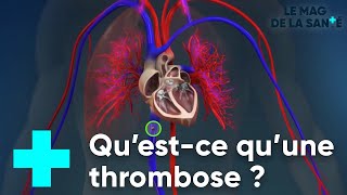 La thrombose veineuse  Le Magazine de la Santé [upl. by Vogeley]