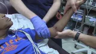 Posterior Elbow Dislocation Reduction [upl. by Harwell]