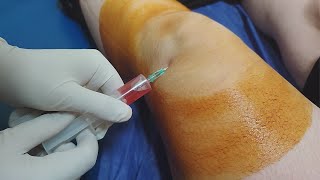 Knee fluid removal  Arthrocentesis  Synovial fluid aspiration procedure [upl. by Rafaelof]