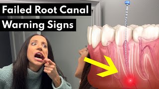 7 Warning Signs Your Root Canal FAILED [upl. by Eelarol]