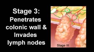 Colon Cancer Diagnosis amp Treatment  Los Angeles Colonoscopy [upl. by Joliet]