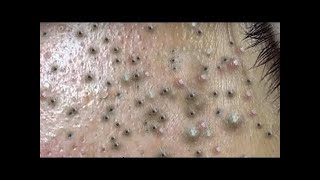 pimple popping relaxingpimples popping big pimple removal [upl. by Jeth]