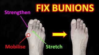 How To Fix Bunions The 4 Most Effective Exercises amp 3 Causes [upl. by Atteselrahc227]