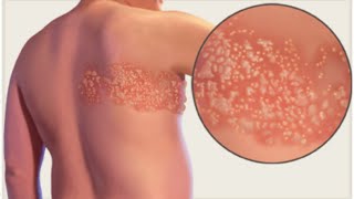 Herpes Zoster Shingles [upl. by Birmingham]