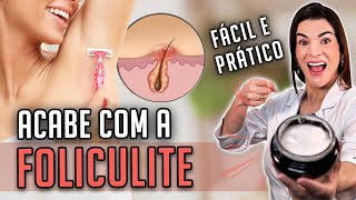 ACABE AGORA COM A FOLICULITE [upl. by Novihc]