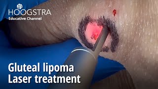 Gluteal lipoma  Laser treatment  24146 [upl. by Saleem439]