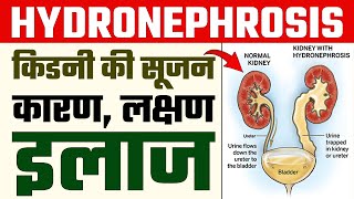 Hydronephrosis in Kidney  किडनी में सूजन के कारण लक्षण और इलाज  DR Puru Dhawan [upl. by Ylecara]