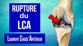 Rupture du Ligament Croisé Antérieur du genou LCA  Les traitements [upl. by Lole]