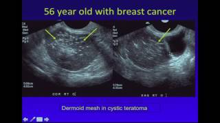 Ultrasound of Adnexal Masses [upl. by Atinuaj430]