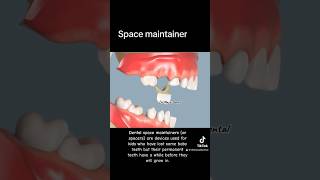 What happens if you dont get a space maintainer [upl. by Phi]