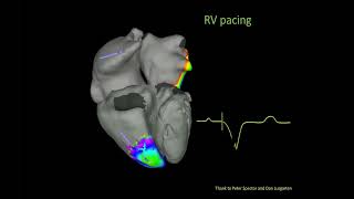 Bradycardia amp Pacing  Cardiology Board Review [upl. by Mcgean]