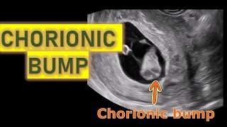 CHORIONIC BUMP IN AN 8 WEEKS GESTATION [upl. by Ayatahs]