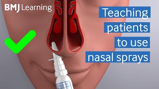 Teaching patients to use nasal sprays  BMJ Learning [upl. by Amlus]