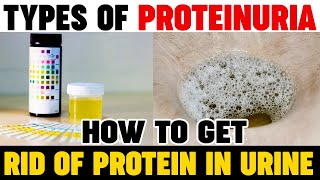 Types Of Proteinuria  How To Get Rid Of Protein In Urine  Kidney Expert  Karma Ayurveda Reviews [upl. by Adnerol]