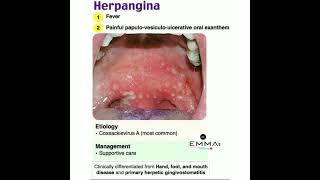 💠 Herpangina 💠 [upl. by Yenor]