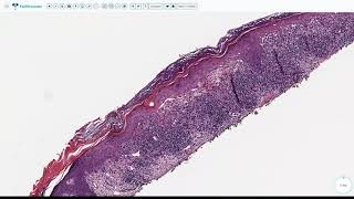 Lecture 3Lichenoid Interface Dermatitis [upl. by Laenahtan]