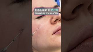 Secretos sobre eliminar ojeras con ácido hialurónico acidohialuronico ojeras [upl. by Drawe872]