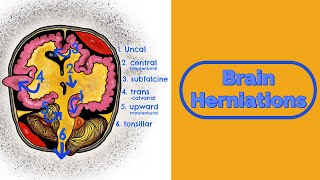 Brain Herniations and Raised ICP [upl. by Yrollam]