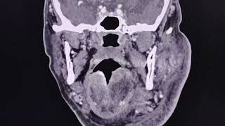 Acute sialadenitis of the parotid gland  CT findings [upl. by Aicetel]