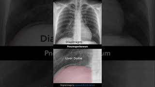 Pneumoperitoneum Chest Xray shorts [upl. by Ruhnke]