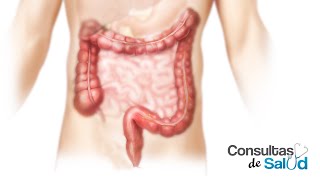 Cuales son los síntomas de Cáncer de Colon y Recto  Consultas de salud [upl. by Uaeb]