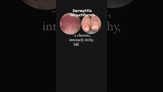 What is Dermatitis Herpetiformis celiacdisease gluten microlearning [upl. by Attena]