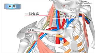 胸郭出口症候群／2分で分かる医療動画辞典 ミルメディカル [upl. by Kurt]