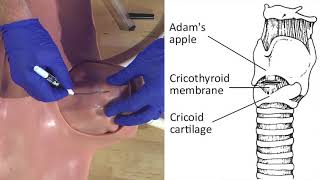 Emergency Needle Cricothyrotomy Procedure Explained [upl. by Argyres]