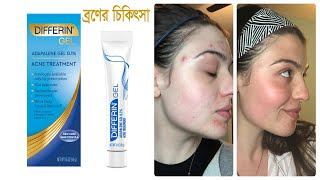 ব্রণ দূর করার জেল  Differin Gel  Adapalene Gel 01  Acne Treatment  Beauty Care  Rupchorcha [upl. by Lednar93]