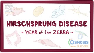 Hirschsprung disease Year of the Zebra [upl. by Arabrab342]