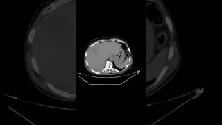 Multiple liver abscess [upl. by Ardelia]