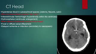 Subarachnoid Hemorrhage [upl. by Aniuqal949]