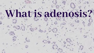 What is Adenosis  Pathology mini tutorial [upl. by Henleigh417]