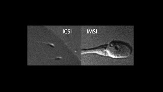 ICSI أو IMSI حقن مجهري بنسب نجاح أكبر [upl. by Ingram]