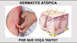 Por que a DERMATITE ATÓPICA coça tanto Por Luiz Gameiro médico dermatologista [upl. by Mccahill202]