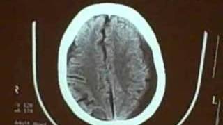 Subdural hematoma [upl. by Brockie]