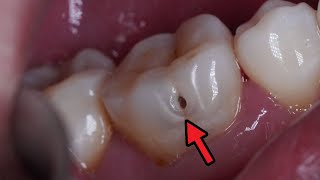 This Tooth Hole Looks Small But Inside There Is Widening Damage [upl. by Barcot]