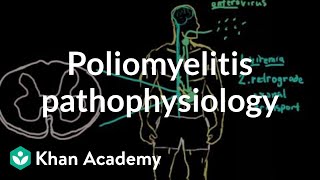 Poliomyelitis pathophysiology  Infectious diseases  NCLEXRN  Khan Academy [upl. by Pangaro269]