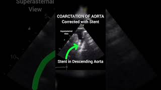 Coarctation Of Aorta corrected with Stent echocardiography for Beginners cardiology echo [upl. by Eidok]