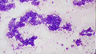 Acinic cell carcinoma FNA Cytology [upl. by Amadeus]