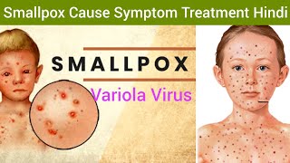 Smallpox Variola Cause Symptoms Diagnosis Treatment in Hindi  Smallpox Hindi  What is Smallpox [upl. by Nigem]