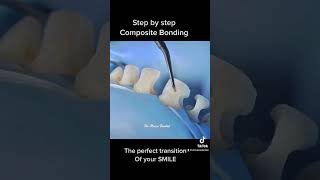 Teeth Composite bonding step by step [upl. by Daughtry]