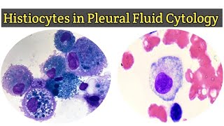 Histiocytes in Pleural Fluid for Cytology  Pleural Fluid Routine Examination [upl. by Calle]