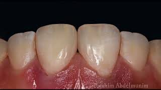 diastema closure using direct composite resin [upl. by Ened989]