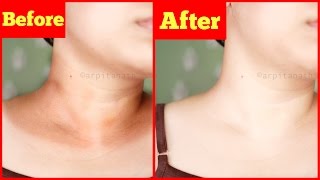 Get Rid of Dark Black Neck in 20 Minutes  Instant Magic Treatment  100 Natural [upl. by Yatnwahs]